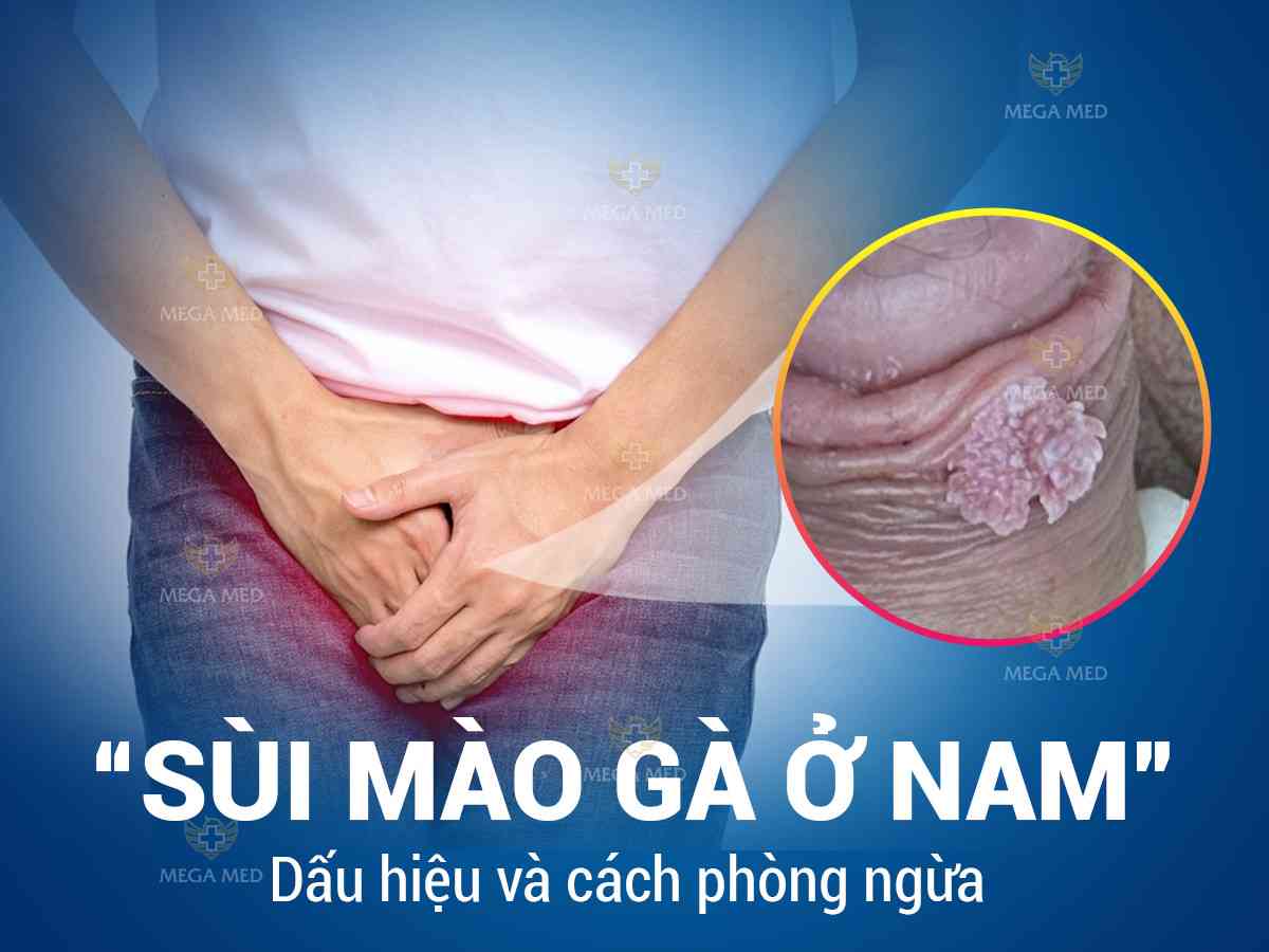Sùi mào gà ở nam